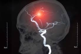 Quali sono le conseguenze e le cause dell'emorragia cerebrale. Aneurisma Cerebrale Cause Sintomi Diagnosi E Cura Assistenza Amica