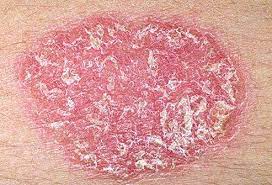 الفصل الثاني تشخيص الأمراض الجلدية Diagnosis of Skin Diseases