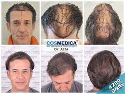 La migliore clinica per trapianto di capelli in turchia. Trapianto Capelli Istanbul Clinica Cosmedica Dr Acar