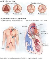 Tavr A Plea To Refer Patients For Consideration Heart And Vascular Health Aortic Valve Replacement Cardiothoracic Surgery Surgery Nursing