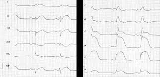 (studiocasper / istockphoto) eine myokarditis ist eine entzündliche erkrankung des herzmuskelgewebes. Ekg Bei Myokarditis Fokus Ekg