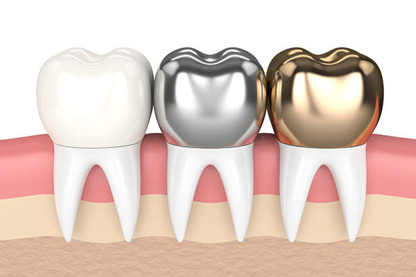 CEREC Crowns vs Traditional - Which Is Better, Bonded or Cemented in Place?