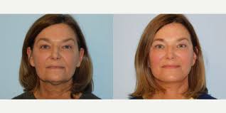 Top Buccal Fat Removal Doctors in Bala Cynwyd, PA