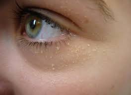 Maybe you would like to learn more about one of these? How To Get Rid Of Whiteheads And What Causes Them