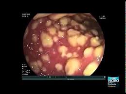 We did not find results for: Endoscopic Imaging Of Clostridium Difficile Colitis Youtube