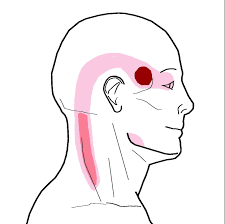 Pin On Migraine