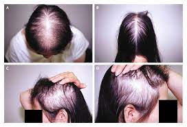 Spironolactone does many things to our bodies. Hair Loss In Women Baltimore Outloud