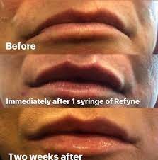 Dermal fillers always cause swelling, and your lips won't look so swollen or unbalanced after a few days. Lip Injections Restylane Refyne Blume Skin Treatment