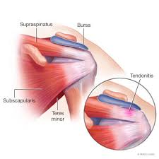 Travels through narrow groove at front of shoulder bends through 90 degrees to enter shoulder joint. Rotator Cuff Tendonitis And Tears Mayo Clinic Orthopedics Sports Medicine