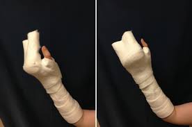 Image result for Radial Gutter Cast