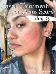 58 top Laser Scar Removal in Ghana ideas in 2025