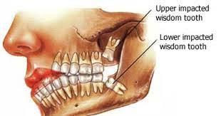 Fenton can evaluate the position of the wisdom teeth and predict if there are present or future potential problems. Wisdom Tooth Extractions Waterloo On Eastbridge Dental Care