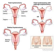 Most women with vulvar intraepithelial neoplasia (vin) have no symptoms at all. Vaginal Cancer Facts Symptoms Information Dana Farber Cancer Institute Boston Ma