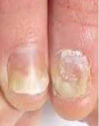 33 na psoríase ungueal, a dermatoscopia permite analisar com maior pormenor alterações da matriz (picotado) e do leito (onicólise, manchas salmão e hemorragias em estilhaço). Tatamento Correto Psoriase Das Unhas