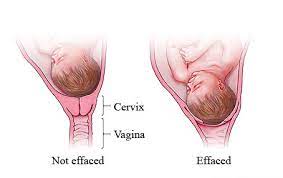 What Does 1 Cm Dilated 50 Effaced Mean New Health Advisor