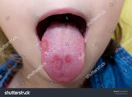 Image result for mouth ulcer on tongue)