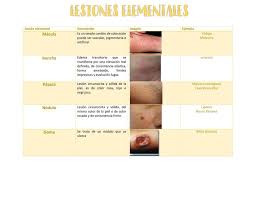 Estas aparecen de novo es decir sobre una piel intacta (normal). Lesiones Elementales Udocz