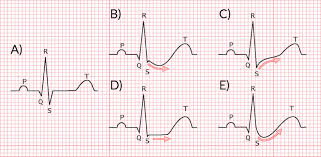 Ecg interpretation of st segment elevation and possible stemi by dr. Acute Coronary Syndrome Amboss