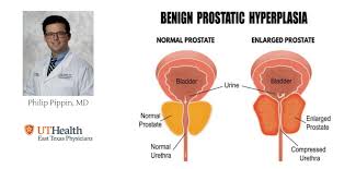 It can press on the spinal nerves, causing pain or numbness, and. Men S Health Month Benign Prostatic Hyperplasia Ut Health East Texas Physicians