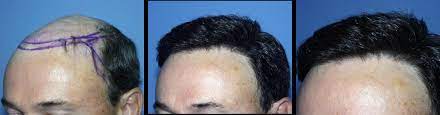Hair System And Hairline Surgery Chicago Oak Brook Il Chicago Hair Institute