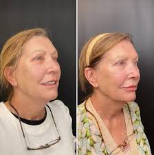 The Art of Jawline Sculpting: 3 Cutting-Edge Treatments Recommended by  Facial Experts — Skincare by Amy Peterson