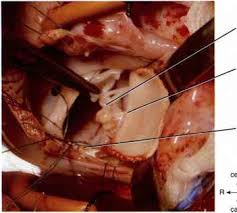 Dacron needs to be heated with an iron to the correct temps for the maximum tautness. Complete Atrioventricularis Communis Or Atrio Ventricular Canal Pulmonary Artery