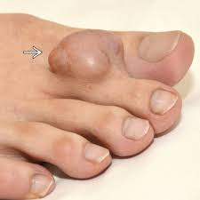 Image result for Dermatofibrosarcoma Protuberans