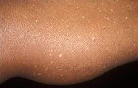 White Bumps On Skin Little Dry Hard Itchy White Spots Dots Skin Bumps From Sun White Bumps On Skin Skin Bumps Itchy Skin