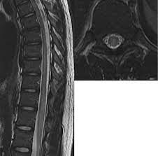The segment of the spinal cord that has inflammation or damage determines the symptoms a person has. Neuroimaging In Acute Transverse Myelitis Neuroimaging Clinics