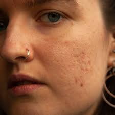 You're Probably Making This Huge Acne Mistake Right Now