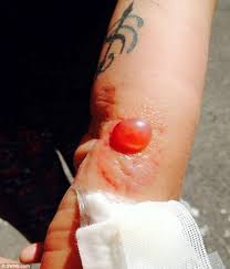 Though they are less common it can happen; Pictured Horror Bite Of False Widow Spider Leaves Pub Landlady With Grotesquely Swollen Sore On Her Arm Daily Mail Online