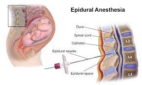 Epidural Risks Mother Baby
