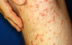 Allergic Reaction Black Ant Bites Pictures Allergic Reaction To Ant Bites Beautiful
