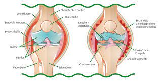 Arthrose Beschwerden Ursachen Behandlung A Vogel