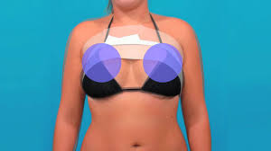 We did not find results for: Breast Implant Exercises From Dallas Plastic Surgeon Dr Bogdan 2301 Plastic Surgery
