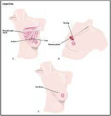 Yes, it feels like a bruise, but doesn't look like one. Lumpectomy Procedure Pain Complications Time Infection Operation Medication Pregnancy