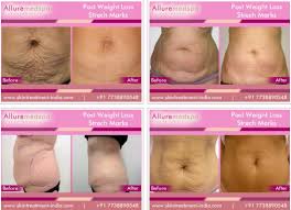 Pin On Skin Treatment India