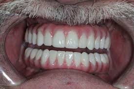 We did not find results for: Dental Implants Before And After Cases Gordon Dental