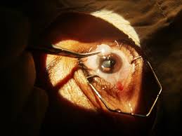 Answer is yes, cataract surgery is covered in health insurance. Cataract Surgery Overview