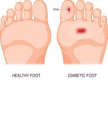 Image result for toe amputation