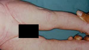 The nerve supply that is used to the fine blood vessels especially on the upper skin layer is still very much immature. Cutis Marmorata Symptoms Pictures In Adults And In Newborns