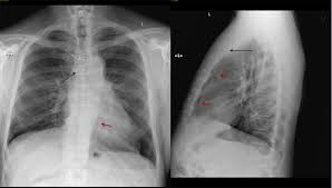 Intervento Di Bypass Aorto Coronarico Disturbi Dell Apparato Cardiovascolare Manuali Msd Edizione Professionisti