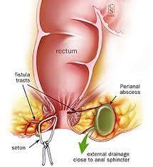 Image result for anal fistula