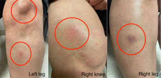 Image result for erythema nodosum