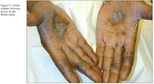 Image result for Lichen Simplex Chronicus