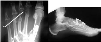 The injury occured when i tripped over something and my now though, it pains me all the time and it seems to be regressing with pain and bruising. Third And Fourth Metatarsal Neck Fracture Treated With Transverse Download Scientific Diagram