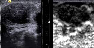 Ibc is a rapidly progressive, aggressive form of breast cancer associated with a low overall survival rate. Controversies And Practices In Breast Cancer Screening Healthcare In Europe Com