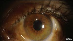 Image result for melanosis sclera