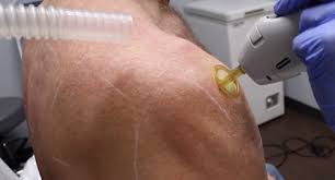 Up to 75% faster treatment time. Lightsheer Duet Laser Hair Removal San Diego Ca Clderm