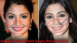 22.10.2010 · nene leakes' plastic surgery before & after: Bollywood Actresses Before And After Plastic Surgery